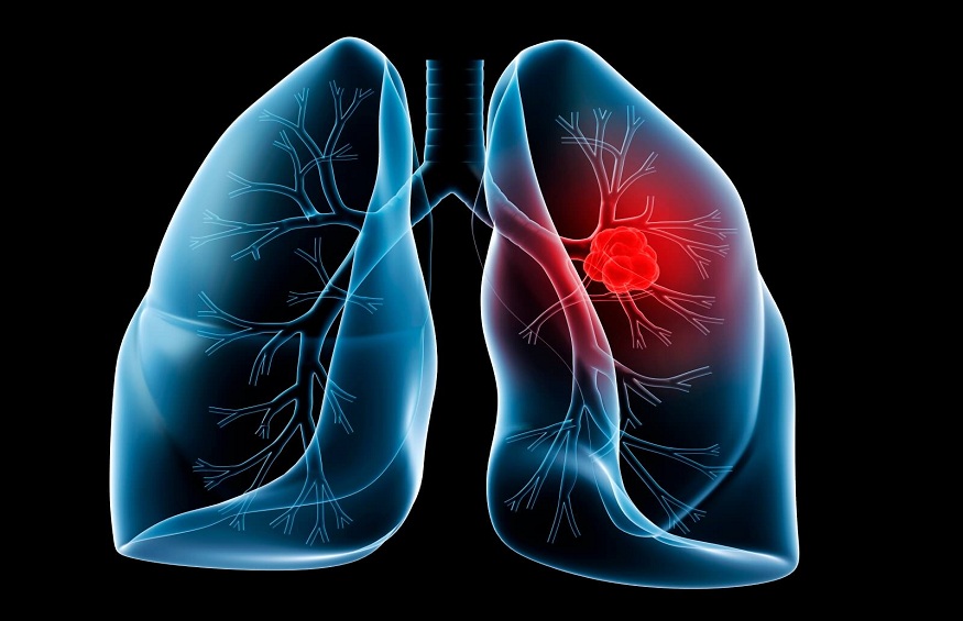 Lung Cancer Screening